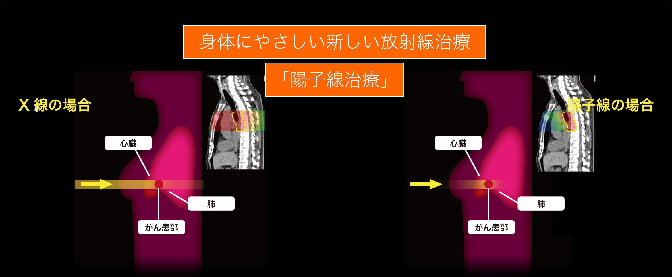身体にやさしい放射線新しい治療